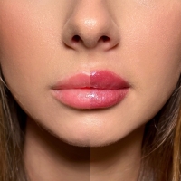 Lip Volume